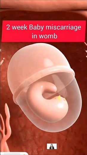 2 Month Miscarriage Explained | 3D Animation | What Happens Inside the Body #baby #pregnancy