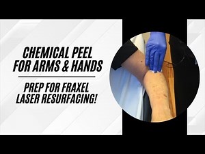 Chemical Peel on Arms and Hands | Prepping the Skin for Fraxel Laser Resurfacing | Live