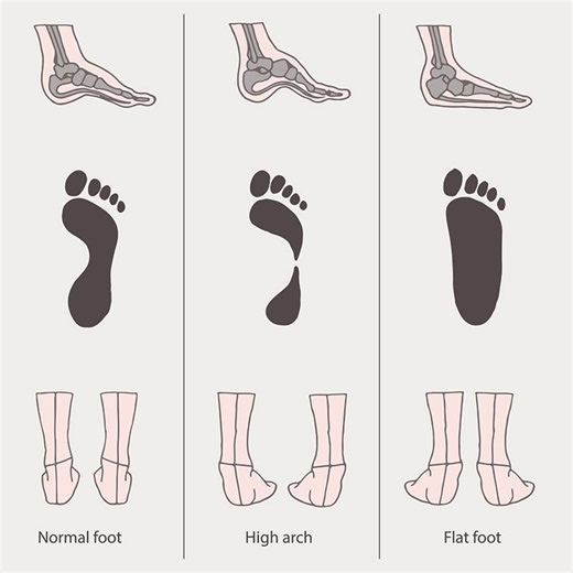 How to Identify a High Instep: Practical Tips for Foot Shape and Comfort - Smart.DHgate – Trusted Buying Guides for Global Shoppers