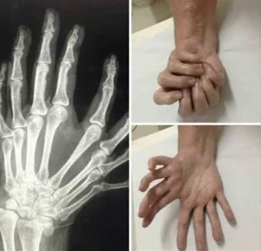 X-RAY TECHNICIAN 🥼🩻 on Instagram: "In a typical hand, we have a radius bone (thumb side) and an ulnar bone (pinky side). In cases of Ulnar Dimelia: ​The radius is absent. ​The ulna is duplicated, meaning there are two ulnar bones in the forearm. ​Because the thumb develops on the radial side, the absence of the radius results in a hand with no thumb. ​Instead, the fingers are mirrored, often resulting in seven or eight fingers that look like a set of "double" pinky, ring, and middle fingers. #