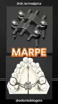 MARPE : Mini implant-assisted palatal expansion for adults