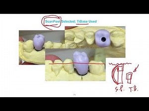 CEREC TiBase Lecture Series Lesson 05