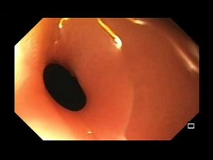Descending Colon Retroperitoneal Perforation • Video • MEDtube.net