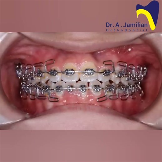 Fixed Orthodontics Before & After | Braces, Amazing Results #dentist #orthodontics #braces #smile
