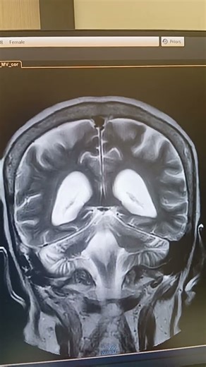 #radiology#mri-brain#medicaltranscription###