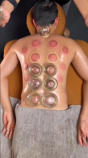 The Science Behind Cupping Therapy