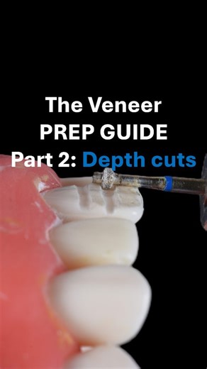 Manav Kalra | MDS - Prosthodontics on Instagram: "The Veneer Prep Guide – Part TWO: The Depth Cuts Facial Reduction: 0.5 mm 👉Depth-cut burs are self-limiting. Unlike traditional burs, there’s no need to control the cutting pressure. Allow both ends of the bur shank to rest against the facial surface—once this happens, the desired depth of 0.5 mm has been reached 👉 Use the bur in a uniform, sweeping motion, ensuring the full depth is achieved from the mesial to the distal line ang