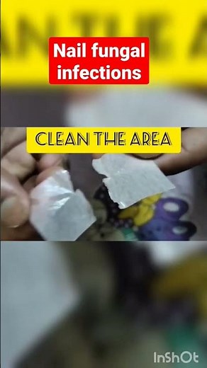 NAIL FUNGUS TREATMENT BY LOCERYL LIQUER