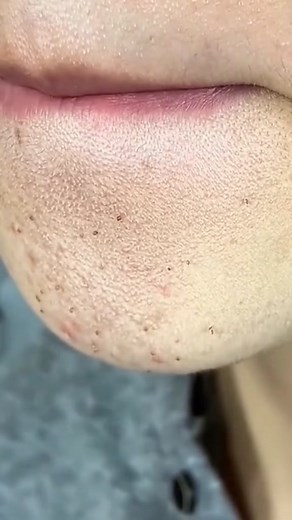 Green mask stick 🤡🤡 #greenmaskstick #porevacuum #porecleaning #extractions #greenmask #acneskincareroutine #skincareviraltiktok #skincarevideo