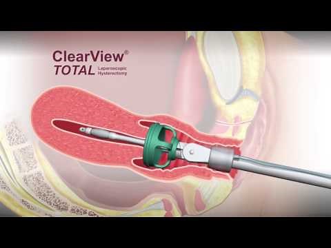 ClearView® TOTAL Uterine Manipulator - Animation