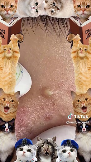 My god!!!😱💕#pimple #cyst #blackhead #USblackhead #cystpopping #fyp