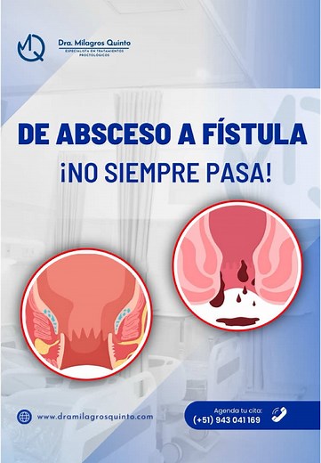 ¿Abceso Anal y Fístula Perianal? Explicación Clara
