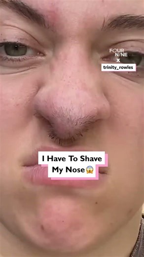 I had a skin graft from my head and now my nose grows hair #shortsfeed #skin #nose #shorts #head