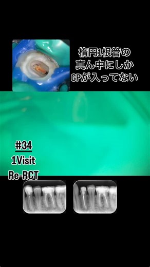 Shuhei Takahashi D.D.S Ph.D | 【ガッタパーチャー除去法】 ガッタパーチャーの除去は再根管治療をする上で1番嫌いな作業ではないでしょうか？？ 取り方としては ①NiTiなどのファイル ②GP溶解剤の使用 ③超音波チップ ④GPリムーバー などがあります。 が、最初に知っていて欲しいこととしては... | Instagram