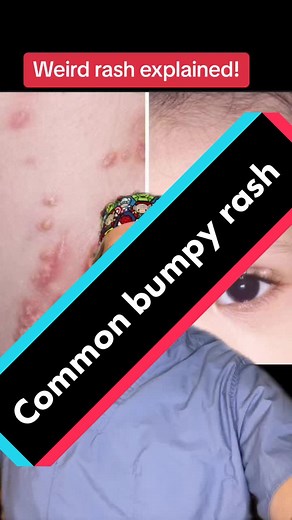 Understanding Molluscum Contagiosum in Children