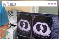 近日，四川成都一市民翟先生称其母亲在四川省人民医院就诊做CT时被误诊为“特发性肺间质纤维化”，在服用约3个月药物后复查时才发现系误诊，院方表示目前双方正对此事协商处理中_腾讯新闻