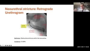 Surgical Complications of Masculinizing Genital Gender Affirming Surgery