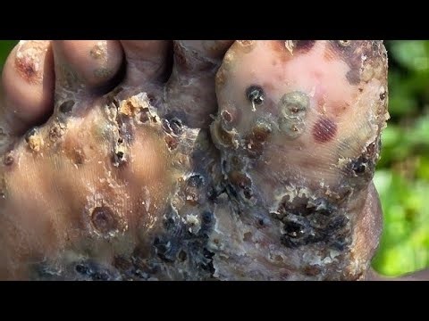 Extreme Tungiasis Cleaning | #Shorts
