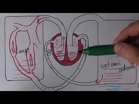 Heart Failure 4, Causes of right ventricular failure