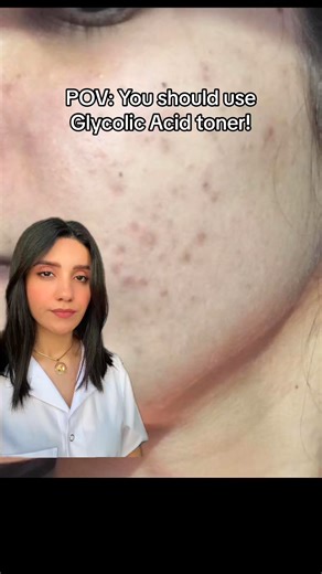 17K views · 87 reactions | Alpha hydroxy acids like glycolic acid work by removing the top layers of dead skin cells. Glycolic acid also seems to help reverse sun damage to the skin. People use glycolic acid for acne, aging skin, dark skin patches on the face, and acne scars. #acne | Dr. Farzan | Facebook