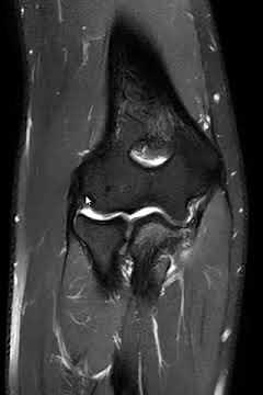Ulnar collateral ligament (UCL) tear and cortical avulsion from the sublime tubercle