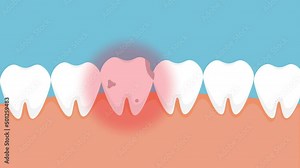 Dead tooth hurting and giving a red pain signal 4K animation. Tooth infected with cavities and hurting jaw 4K footage. A rotten dead tooth with a red danger signal and animation.