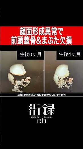 An unprecedented, incurable disease of unknown cause / Facial dysplasia causing frontal skull and...