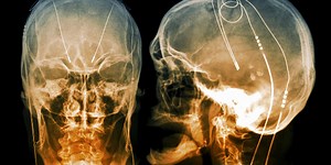 How Do Neural Implants Work?