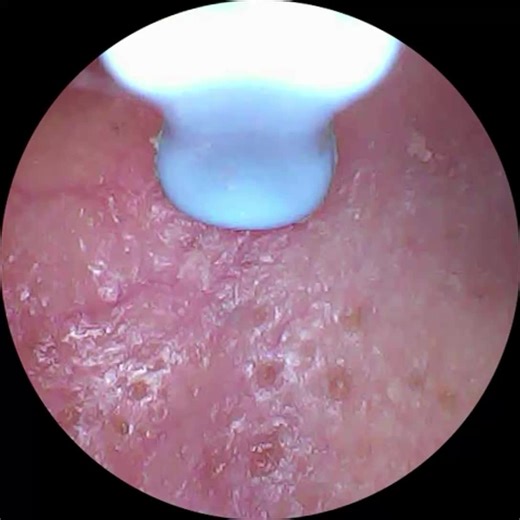Sebum and dead skin cell removal from outer ear #extractions #skincare #satisfying #sebum #earwax