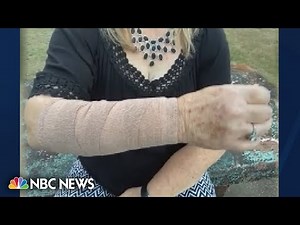 Fangs, feathers and talons: Snake & hawk attack Texas woman