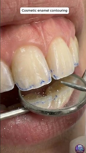 How Uneven Teeth Are Smoothed 🦷 Cosmetic Enamel Contouring Explained | AI Educational Video Only