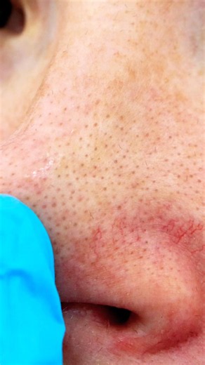 Black Spots on Your Nose? Try These Simple Tips! ✨