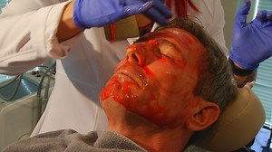 'Vampire facial' gains popularity in North Carolina