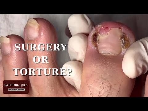 Severe Ingrown Toenail | Curved, Fungus & Painful – Orthosis Applied! #satisfying #nails