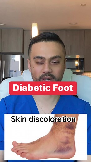 24K views · 225 reactions | How’s diabetes can causes skin discoloration of the legs and feet. #diabetes #diabetesawareness #diabetic #feetfirst #feet #FeetCare #legs #podiatrist #podiatry #podiatrylife #doctor #doctors #medicine #vascular #surgeon #bloodcirculation #health | The Good Foot Doctor | Facebook