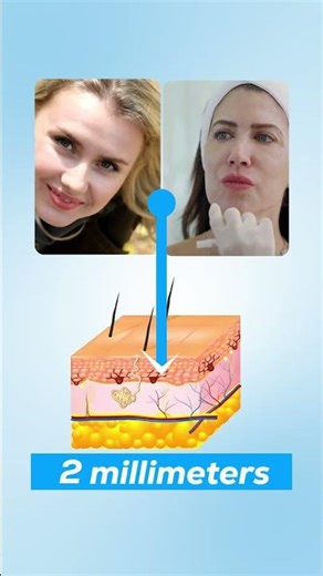 Facial Mapping Before Fillers – Here’s Why It Matters