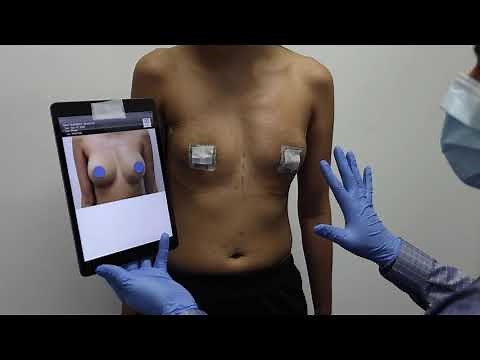 Breast Implant Removal: Textured Silicone Implants & Breast Lift (BEFORE & AFTER S 5 WEEK POST-OP)