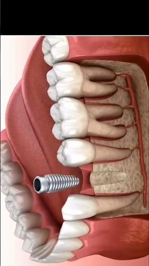 Permanent Tooth Replacement with Dental Implants 🦷 | #dentalimplants