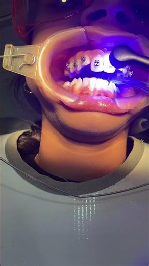 Brackets autoligados metálicos