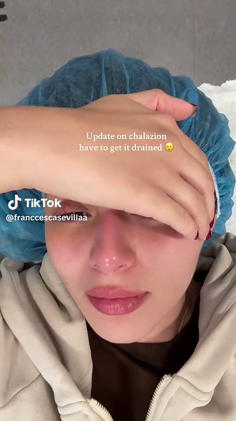 Understanding Chalazion: Symptoms and Treatment Options