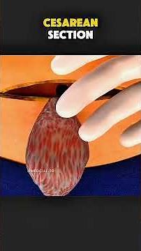 Cesarean Section (C‑Section) Delivery Explained | 3D Animation