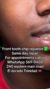 Chipped your tooth? We can help #trinidaddentist #chippedtooth #brokentooth #compositebonding #toothrepair | The Dental Hub