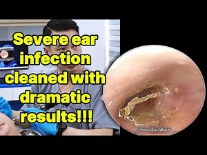 Severe ear infection cleaned with dramatic results | ear cleaning | ASMR earwax | soothing |relax|
