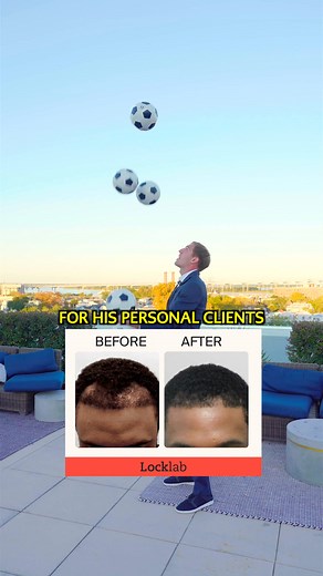 The science is real. Don’t be that guy who still goes bald. ⚪ Locklab is a once-daily pill that’s 97% effective at stopping hair loss and 90% effective at improving hair coverage in men. WHAT MAKES LOCKLAB DIFFERENT? 👑 60% more effective than topicals 🗝 35% more effective than generics 🩺 Created by the President of the ABHRS INGREDIENTS DOCTORS TRUST ⚪ High-Grade Minoxidil, 5mg | Regrow more hair ⚪ High-Grade Finasteride, 1.1mg | Stop hair loss 🌱 High-Grade Biotin, 1mg | Improve hair health 