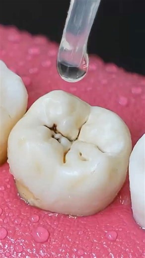 How Do Dentists Remove Those Black Lines on Teeth? 😬🦷