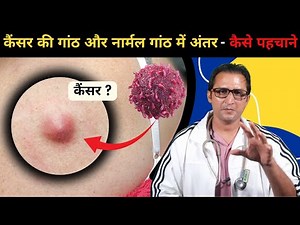 कैंसर की गांठ और नार्मल गांठ में अंतर - कैसे पहचाने | Cancer ki ganth or Normal ganth ke antar