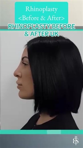 Refined Elegance at 36 👃✨ Our 36-year-old patient felt her nose was too large for her face and wanted a softer, more harmonious appearance. Rhinoplasty was performed to: – Refine a bulbous nasal tip – Straighten the profile – Decrease projection – Correct a deviated septum and adjust the columella angle The result? A beautifully proportionate, natural-looking profile with a gentle curve that enhances her facial balance. 📍Surgery performed by Mr. Taimur Shoaib at Berkeley Square Medical A heart
