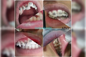 38 reactions · 22 shares | نخستین کلینیک تخصصی #ارتودنسی در افغانستان با بیش از 10 سال تجربه کاری در بخش ارتودنسی آدرس ما سرک 3 پروژه تایمنی منزل تحتانی شفاخانه کابل سیتی شماره های تماس 0787200084 - 0702224545 | Fakhri Dental Clinic کلینیک دندان فخری | Facebook