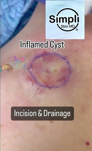Inflamed Cyst Incision & Drainage