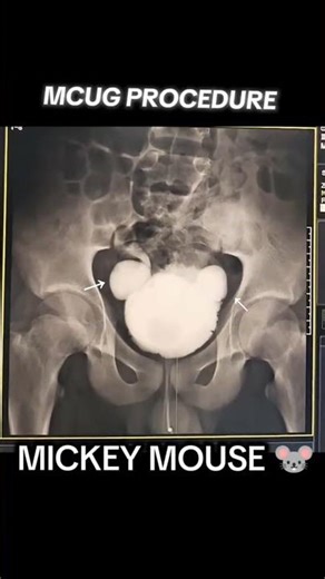 MCUG Procedure by LATERAL VUR #viral #anatomy #humanbody #yt #urinarybladder #urodynamics #ureteric